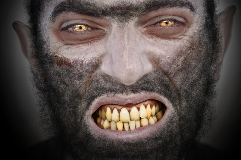 Hipertricosis
