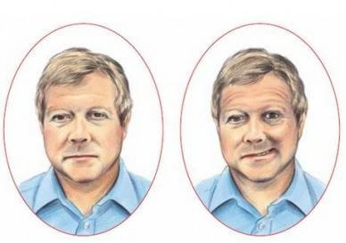 Asimetría facial en el ictus