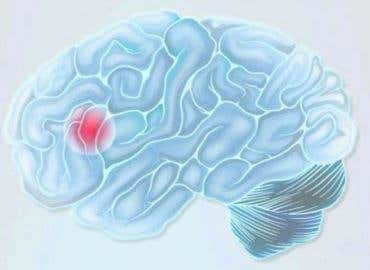 Cerebro con ictus