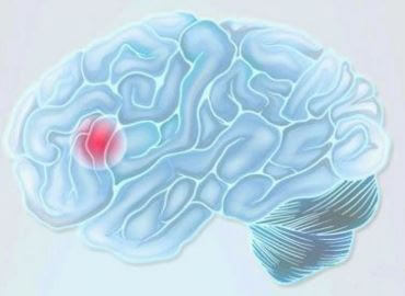 Cerebro con ictus
