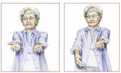 Descenso del brazo en el ictus