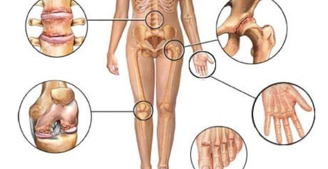 artritis