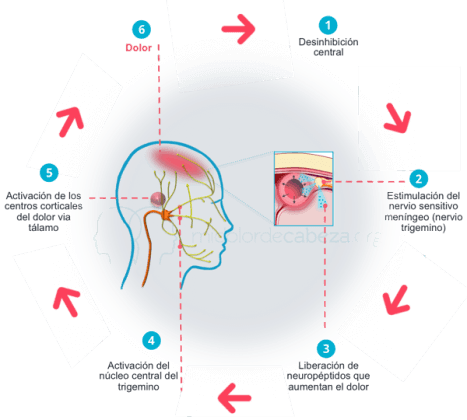 causas del dolor de las migrañas