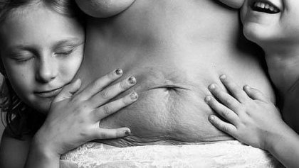 Hay cicatrices que nos recuerdan lo más bello de la vida: los hijos