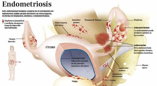 Anatomía de la endometriosis