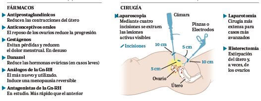 Tratamientos paliativos de la endometriosis
