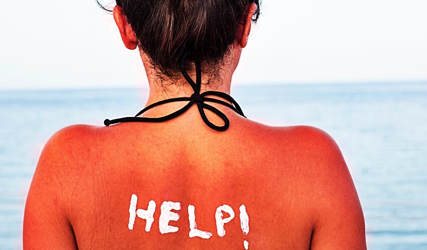 tanorexia piel quemada