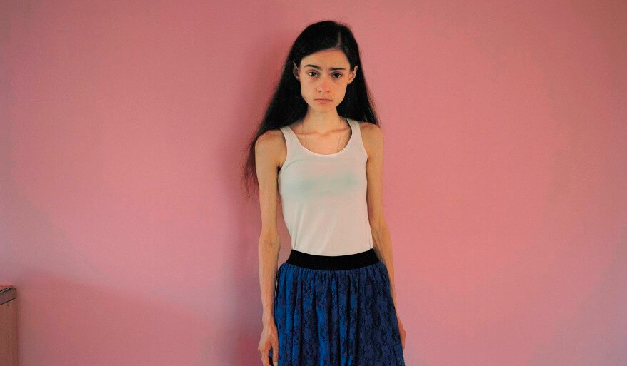 anorexia