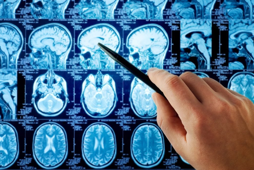 Escáner cerebro