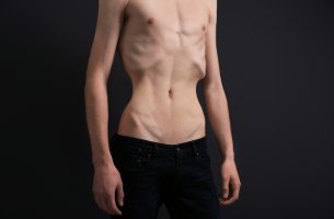 Hombre con anorexia