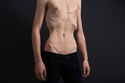 ¿Es la anorexia masculina diferente de la femenina?