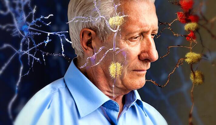 Hombre mayor con alzheimer que necesita omega-3