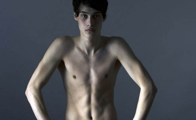 adolescente con anorexia