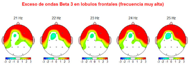 Tratamiento para la ansiedad con neurofeedback