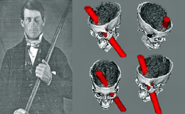 Phineas Gage: clinical cases about the brain