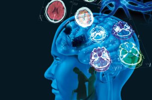 Cerebro de una persona con esclerósis múltiple