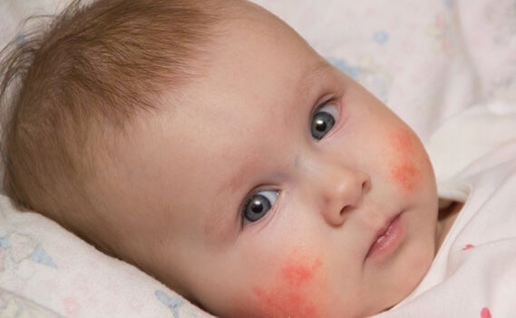 bebé con dermatitis atópica