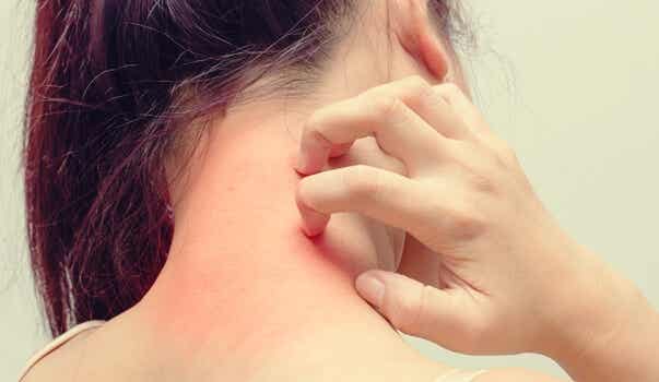 Dermatitis atópica y estrés: ¿cómo se relacionan?