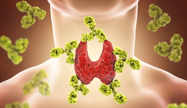Alteración en la tiroides