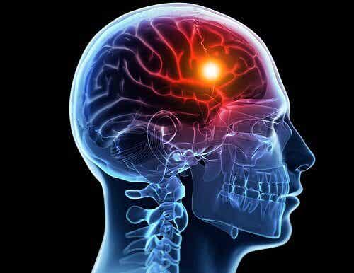 Accidentes cerebrovasculares: causas y tipos