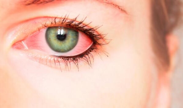 derrame ocular producido por la violencia psicológica