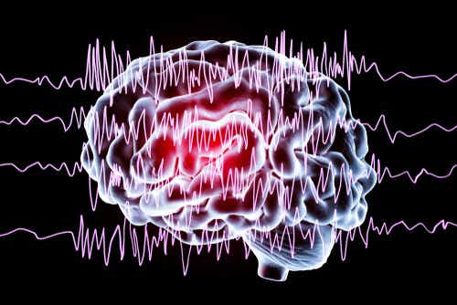 Cerebro con crisis epiléptica debido a una lesión en el lóbulo occipital