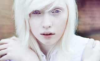 Personas albinas: más allá del aspecto físico