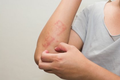 6 consejos para cuidar la piel atópica