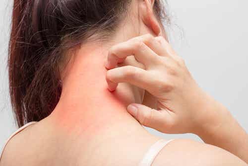 Mujer con dermatitis atópica en el cuello