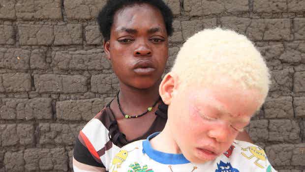mamá africana con su hijo representando a las personas albinas