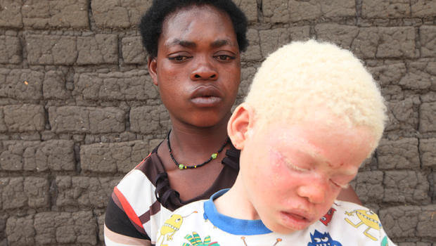 mamá africana con su hijo representando a las personas albinas