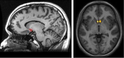 Núcleo accumbens