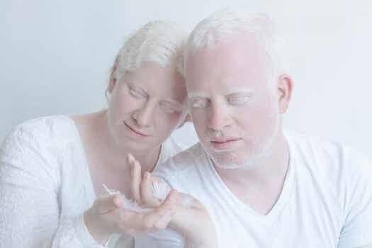 pareja de personas albinas