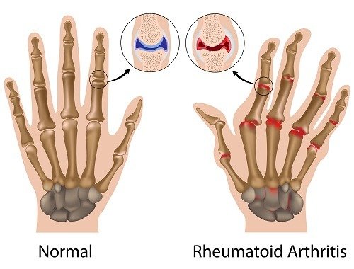 Artritis reumatoide