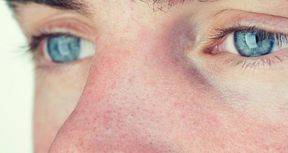 Hombre con síndrome de Waardenburg