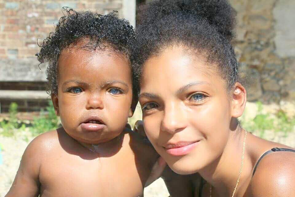 Madre e hijo con síndrome de Waardenburg