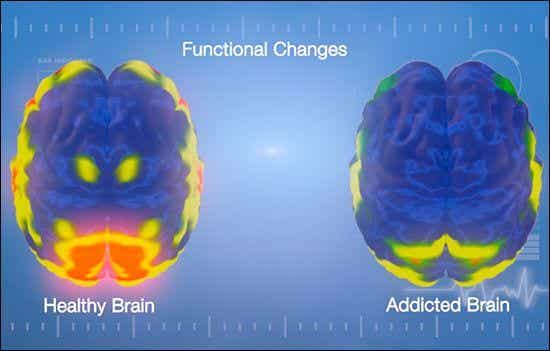 cerebro adicto y cerebro sano