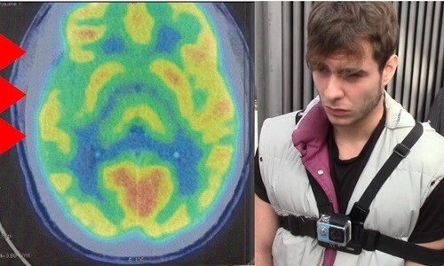 anomalía cerebral de Patrick Nogueira