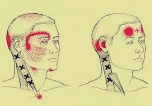figuras simbolizando la cefalea cervicogénica