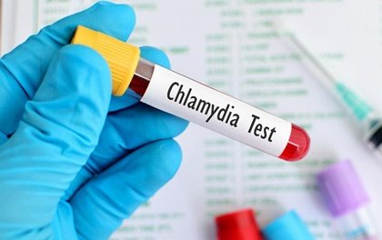 La clamidia, una enfermedad de transmisión sexual muy común