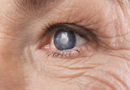 Operación de cataratas: ¿cómo asimila el cerebro los cambios visuales?