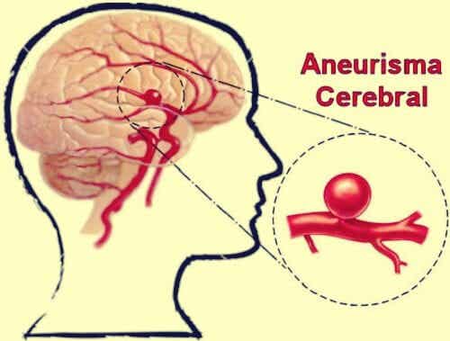 Aneurisma cerebral: definición, síntomas y tratamientos