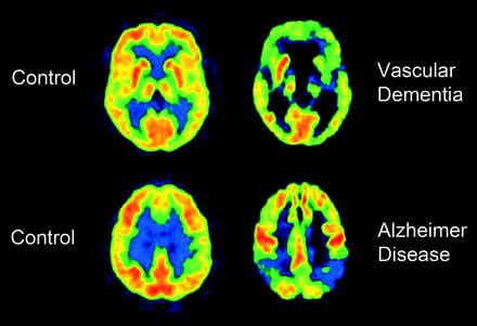 radiografía de la demencia vascular