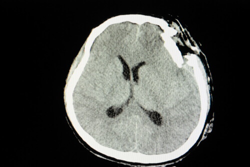 Prueba médica de un traumatismo craneoencefálico