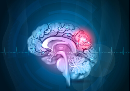 Cerebro con zonas rojas por dolor para representar el chemobrain