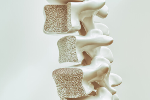 Osteoporosis