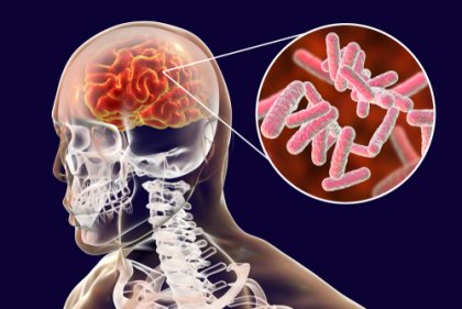 meningitis bacteriana resonancia magnética cerebral