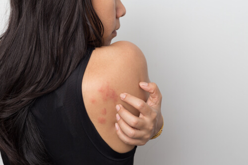 Mujer con urticaria en la espalda