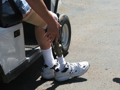 Chica con una pierna biónica