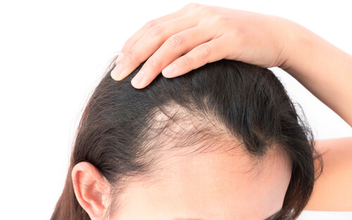 Mujer con alopecia
